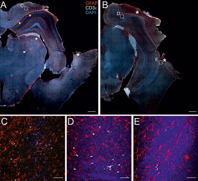 Developmental Dysfunction of the Central Nervous System Lymphatics Modulates the Adaptive Neuro-Immune Response in the Perilesional Cortex in a Mouse Model of Traumatic Brain Injury